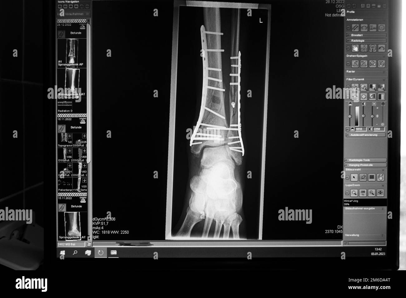 Eine Röntgenaufnahme zeigt eine Fraktur des Sprunggelenks, die mit Platten und Schrauben behandelt wurde Stockfoto