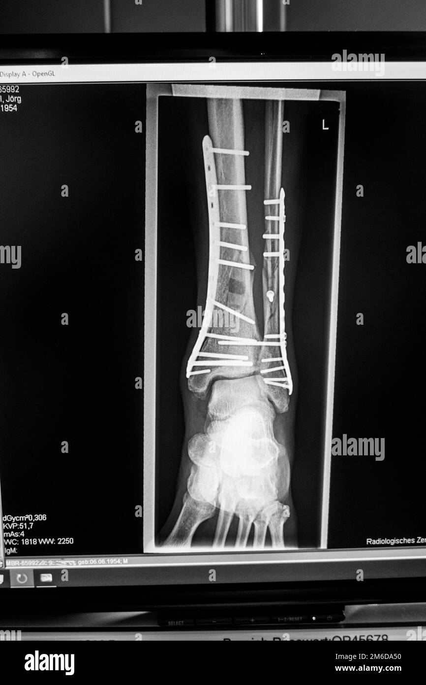 Eine Röntgenaufnahme zeigt eine Fraktur des Sprunggelenks, die mit Platten und Schrauben behandelt wurde Stockfoto