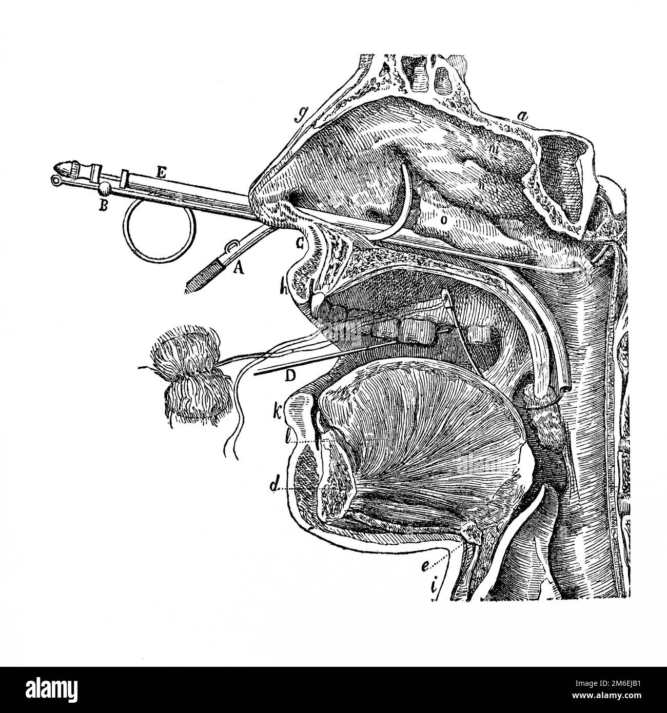 Sonde. Instrument zur Durchführung der Katheterisierung. Antike Illustration aus einem Medizinbuch. 1889. Stockfoto