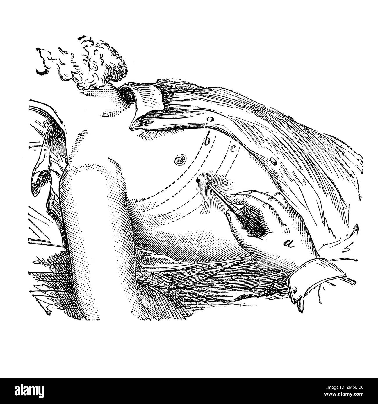 Thorakozentese. Operation, die darauf abzielt, in der Pleura angesammelte Flüssigkeiten zu entfernen. Antike Illustration aus einem Medizinbuch. 1889. Stockfoto