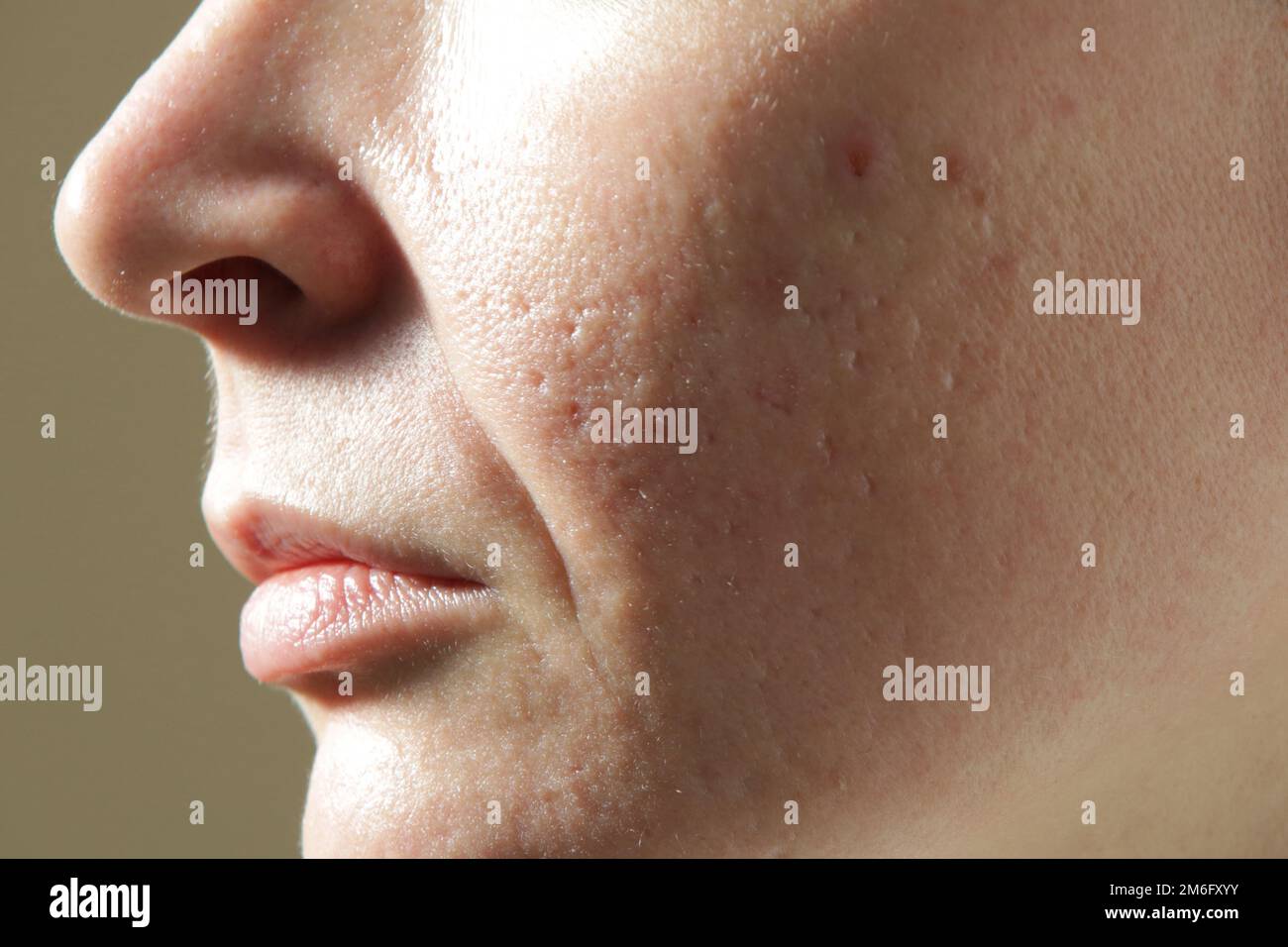 Gesichtsmassage mit Mikroneedle Dermaroller zur Behandlung von Narben, Falten und zur Gesichtsverjüngung. Einfache und billige Hautpflege zu Hause, clos Stockfoto