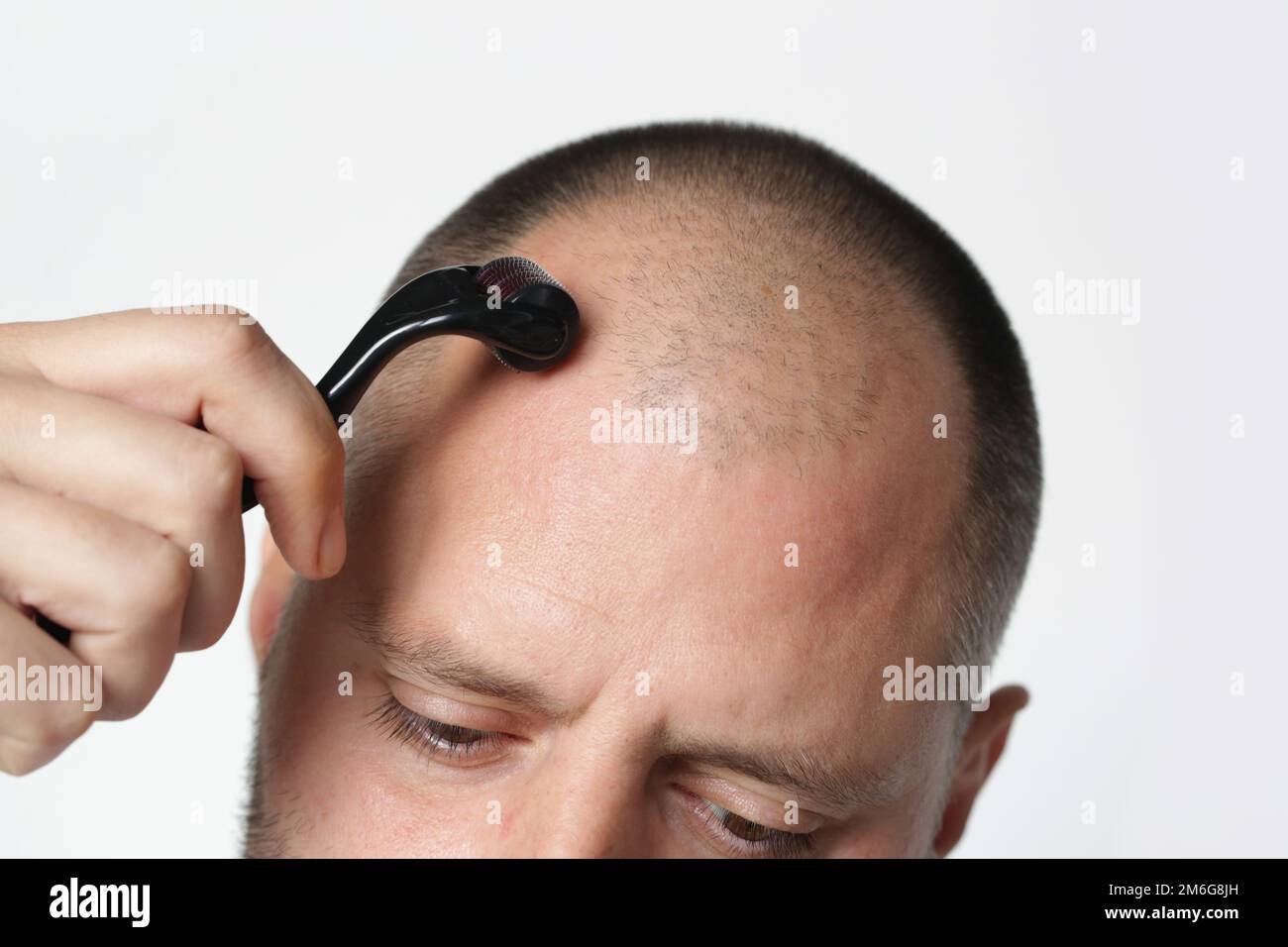 Männer mit Mikroneedle Dermawalze am Kopf zur Stimulierung des neuen Haarwuchses. Einfache und billige Behandlung der Alopezie. Stockfoto