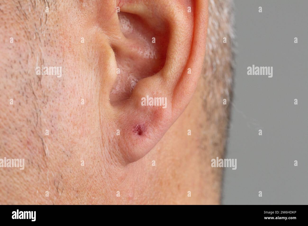 Makro eines Mannes Piercing-Loch in seinem Ohr, mit Reizung durch bakterielle Infektion, die eine Blockade verursacht. Hygienekonzept beim Ohrring-Insertionsverfahren Stockfoto