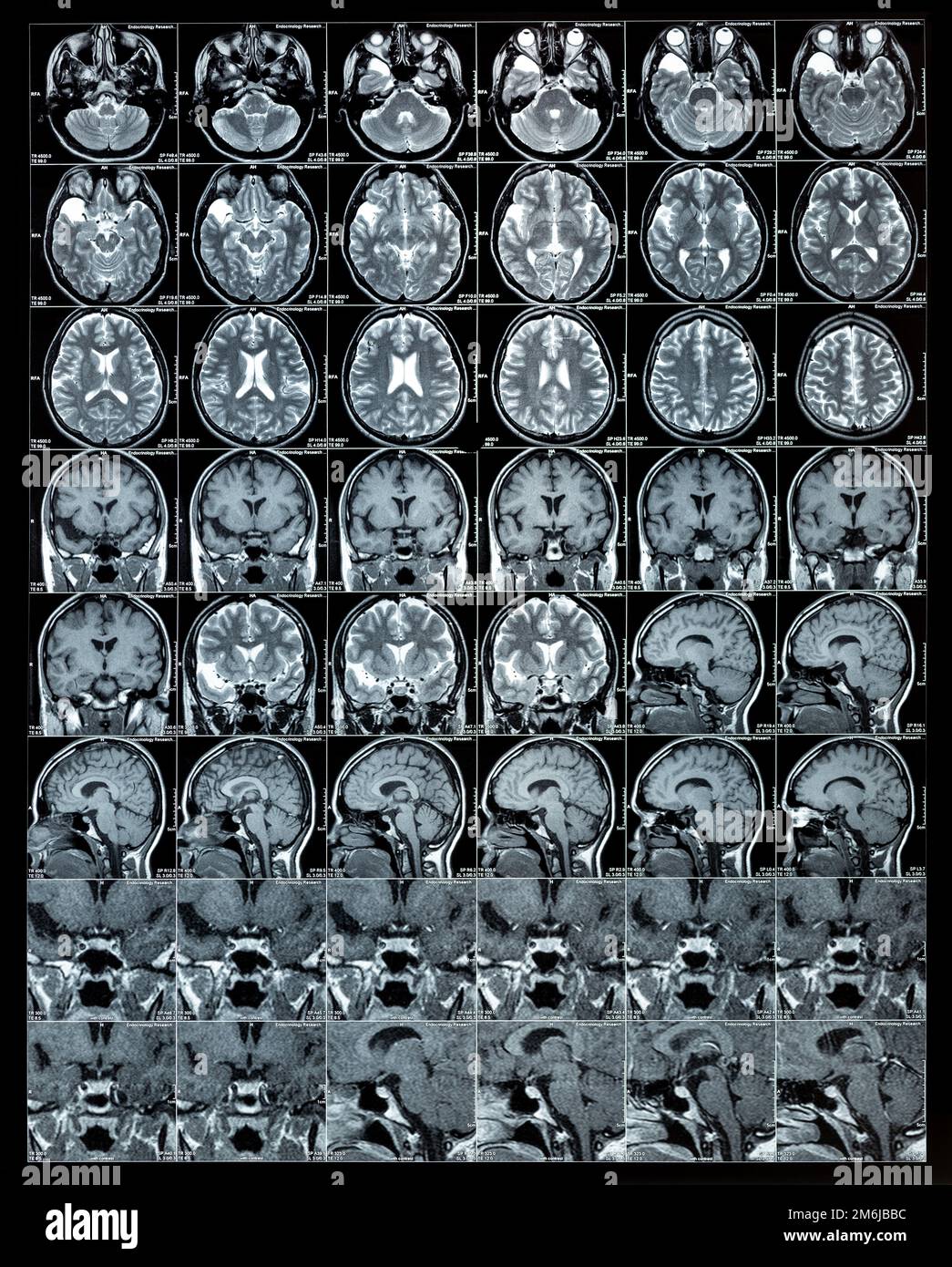 MRT-Hirnscan oder Magnetresonanzbildergebnisse, neurologisches Konzept Stockfoto