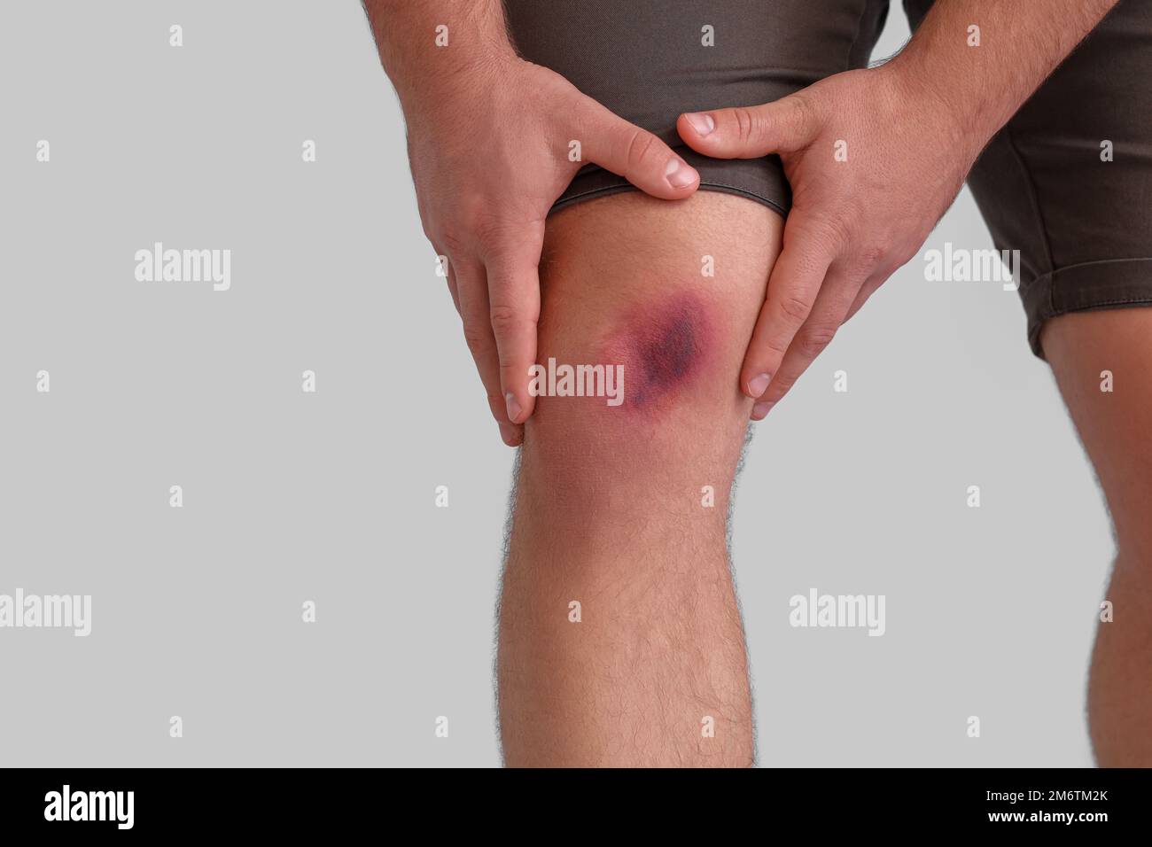 Bluterguss Am Knie Nach Sturz www.alamy.de