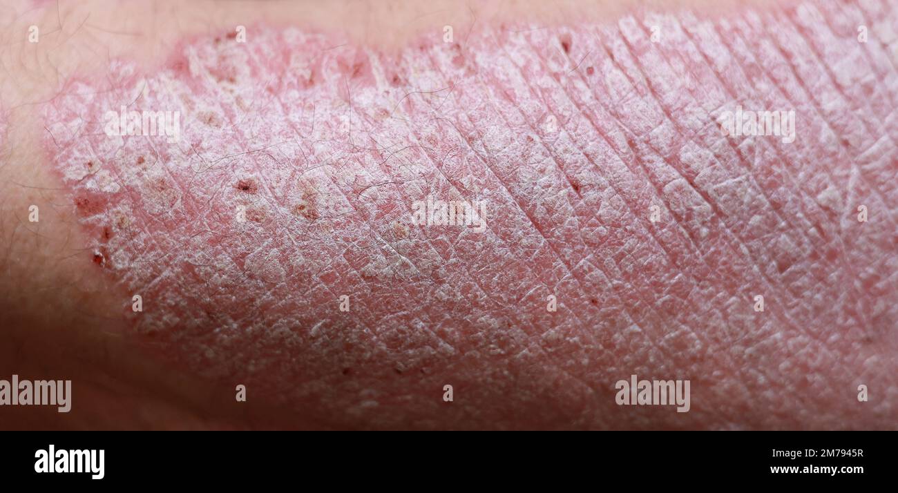 Nahaufnahme, Makro der Psoriasis Haut, Autoimmunerkrankung, die die ...
