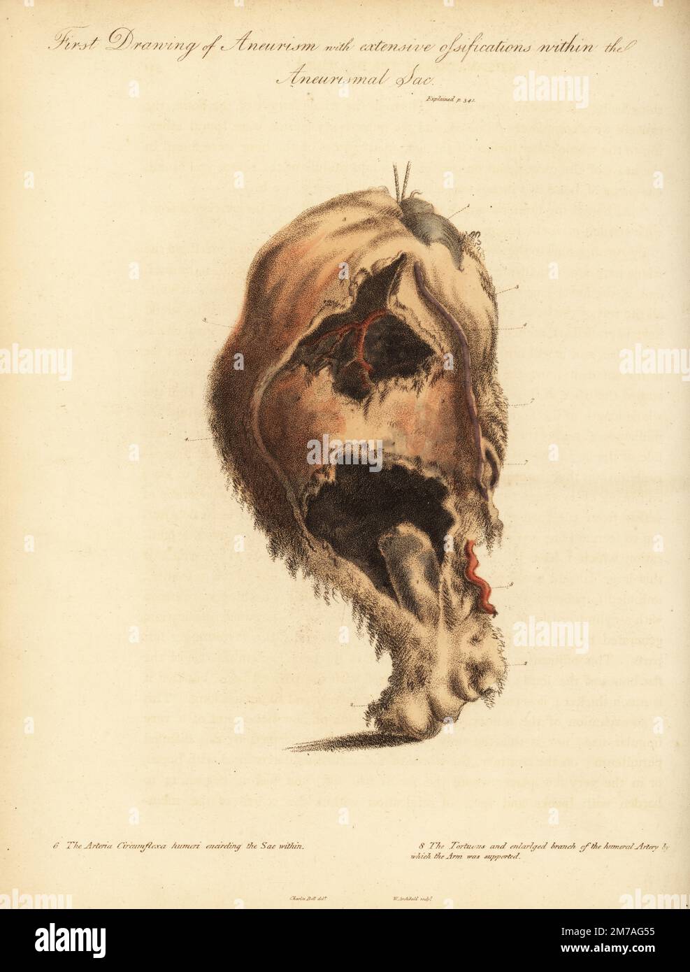 Aneurysmatumor aus dem gebrochenen Arm einer Frau, die von einem Pferd und Karren umgestoßen wurde, 1815. Erstzeichnung von Aneurysma und ausgedehnten Ossifikationen mit dem Aneurismalsack. Kopf des Humerus 1, unterer Teil des Knochens 2, Arteria circumflexa humeri umschließt den Sack innerhalb von 6 und den gewundenen und vergrößerten Ast der Oberarmarterie. Handfarbene Kupferplatte, Gravur von William Archibald, nach einer Illustration von John Bell aus seinen eigenen Prinzipien der Chirurgie, wie sie sich auf Wunden, Geschwüre und Fisteln beziehen, Longman, Hurst, Rees, Orme und Brown, London, 1815. Stockfoto
