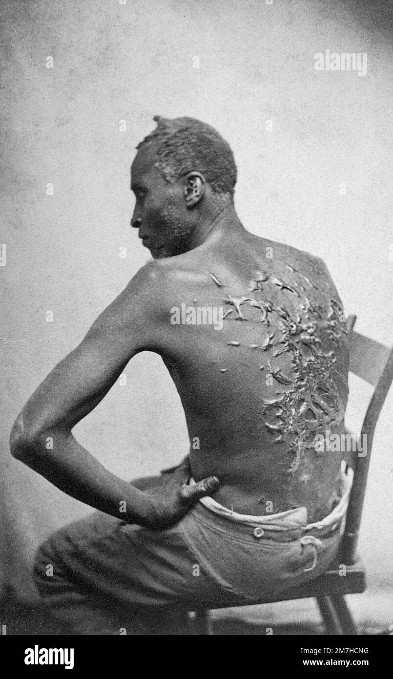 Ein entsetzliches Foto aus dem Jahr 1863, auf dem ein schwarzer Sklave aus Louisiana, bekannt als Peter (und manchmal Gordon), mit seinem Rücken zu sehen ist. Eine Menge hässlicher Narben und Nüsse von einer gewaltsamen Auspeitsche seines Besitzers. Die grafische Natur dieses Bildes machte es zu einer mächtigen Waffe für die Bewegung der Abolitionisten. Stockfoto
