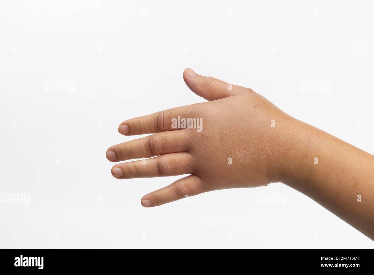 Geschwollene Hand durch allergische Insektenstiche. Hautallergische Pflege. Stockfoto