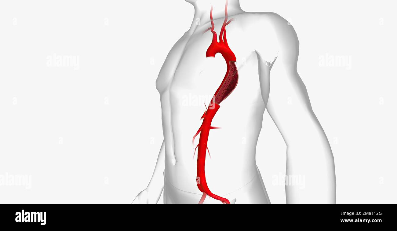 Die Aortendissektion ist eine schwerwiegende kardiovaskuläre Erkrankung ...