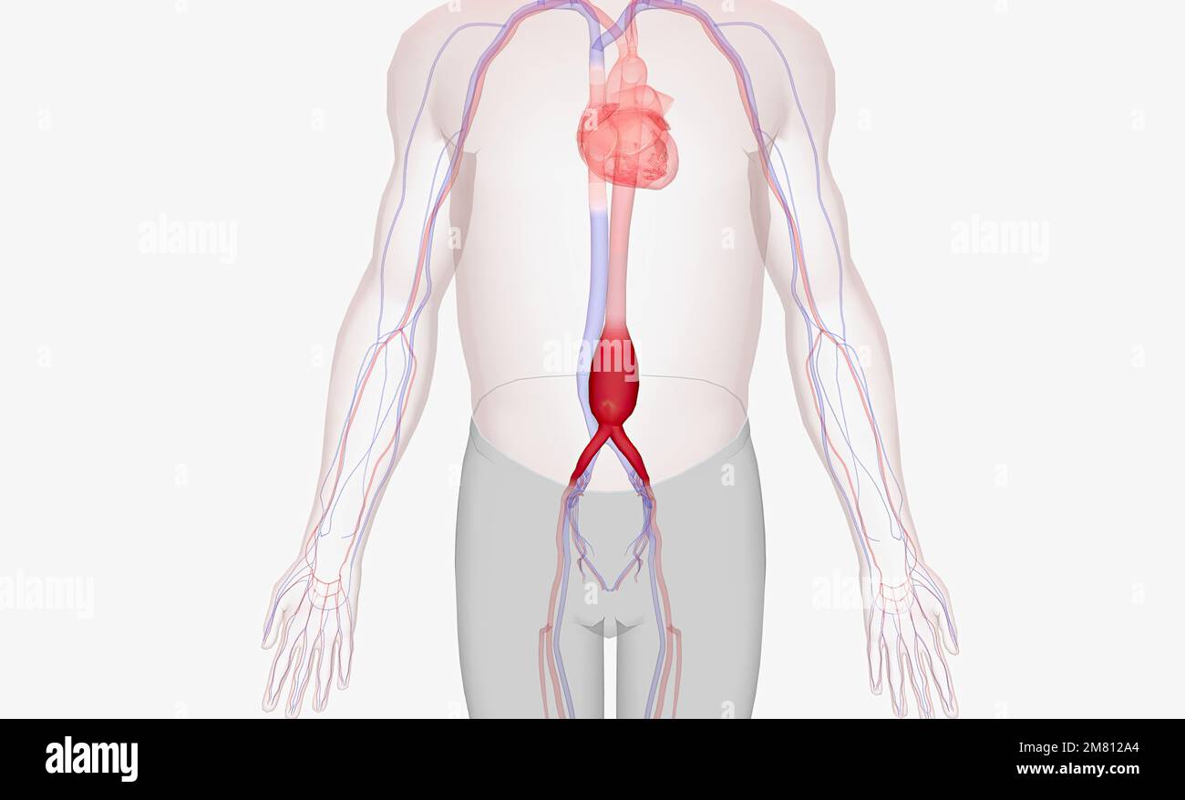 Ein abdominales Aortenaneurysma tritt auf, wenn die Bauchaorta aufgrund