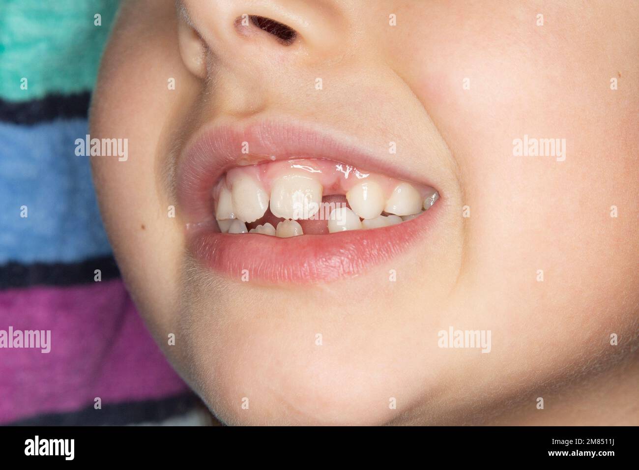 Nahaufnahme eines lächelnden Kleinkindes mit fehlenden Zehen und bleibenden Zähnen - ein gesundes Zahnkonzept Stockfoto