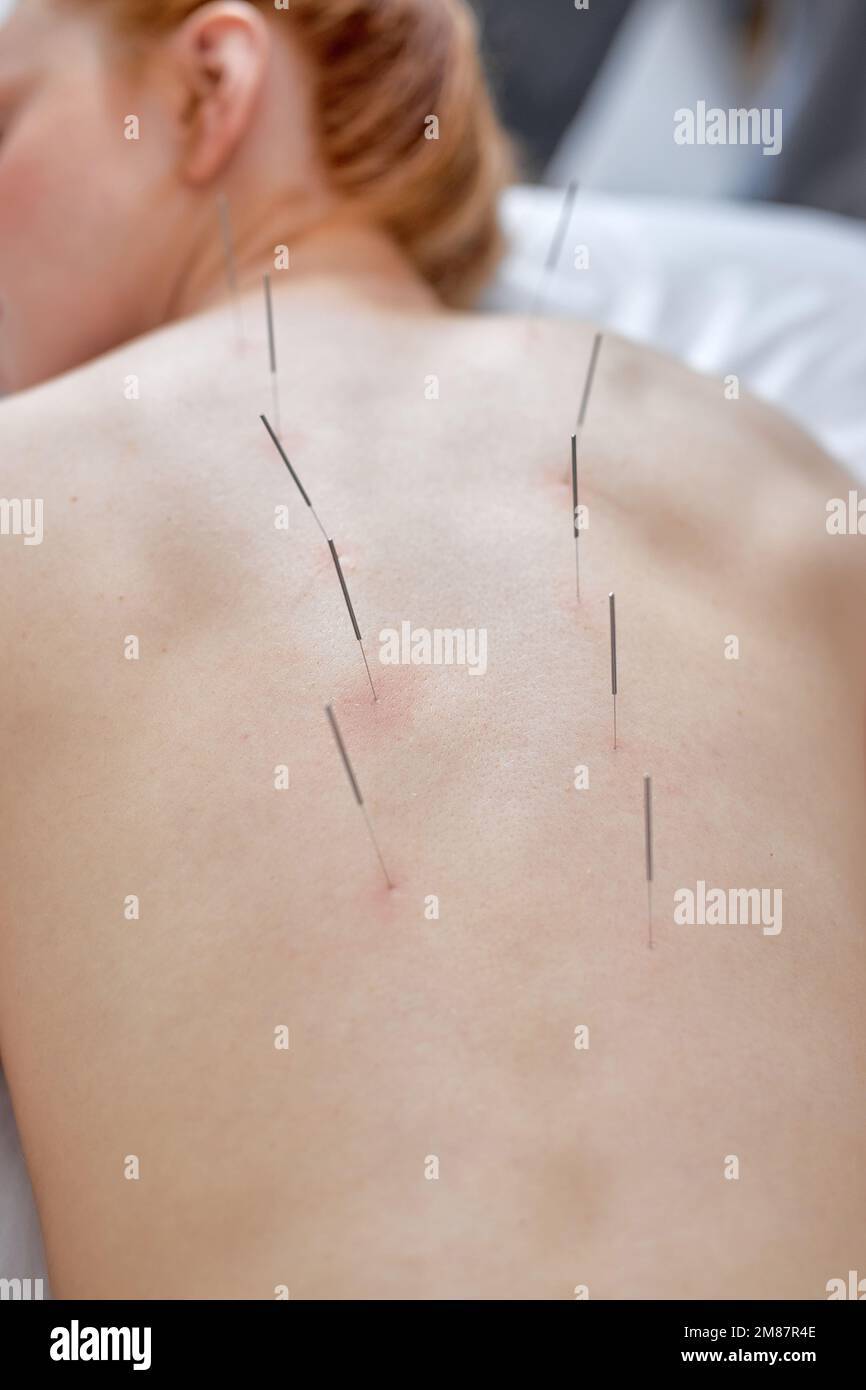Akupunkturtherapie auf Rückenwirbelschultern für weibliche Klientin. Frau, die sich einer Akupunkturbehandlung mit einer Reihe feiner Nadeln unterzogen, die in schlanke b eingeführt wurden Stockfoto