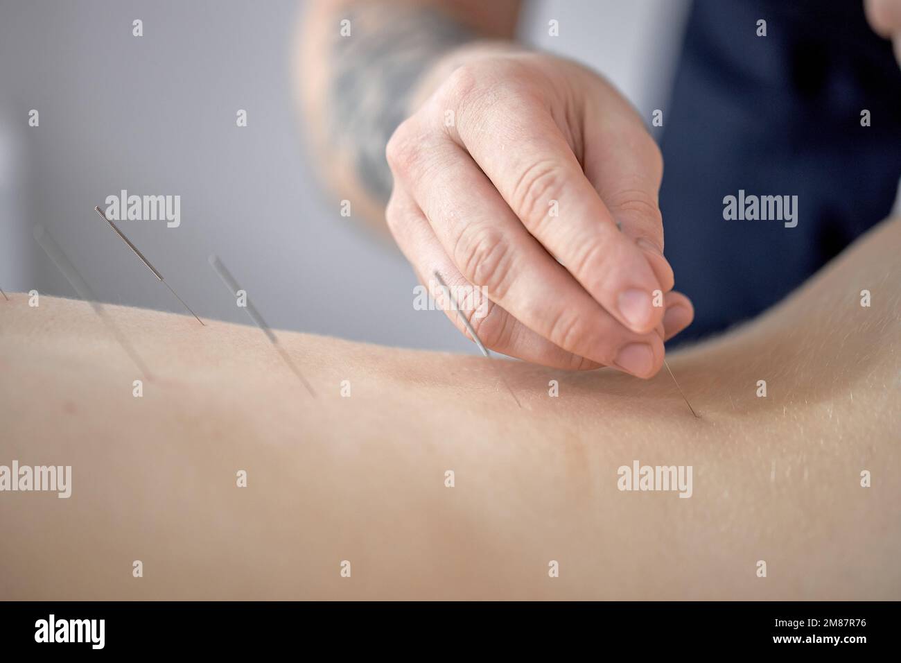 Akupunktur im Rücken eines weiblichen, nicht erkennbaren männlichen Massagisten, der eine Osteoarthritis-Behandlung im Rücken der Wirbelsäule zur Rehabilitation im Klinikspital durchführt. clos Stockfoto