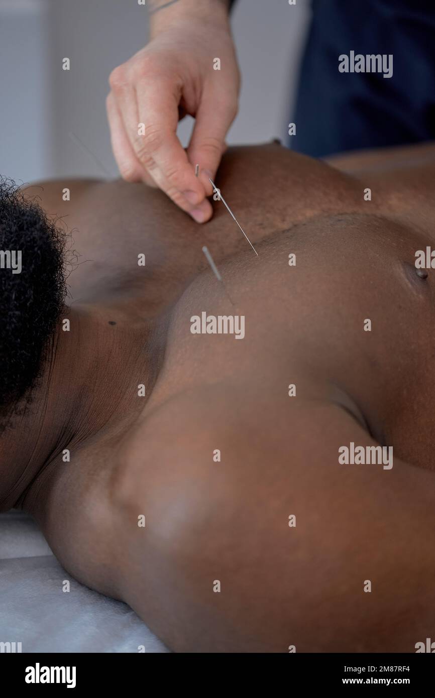 Nicht erkennbarer Facharzt, der Akupunkturtherapie auf der Brust für einen schwarzen männlichen Klienten durchführt. Nahaufnahme. Mann, der sich einer Akupunkturbehandlung mit einem unterzieht Stockfoto