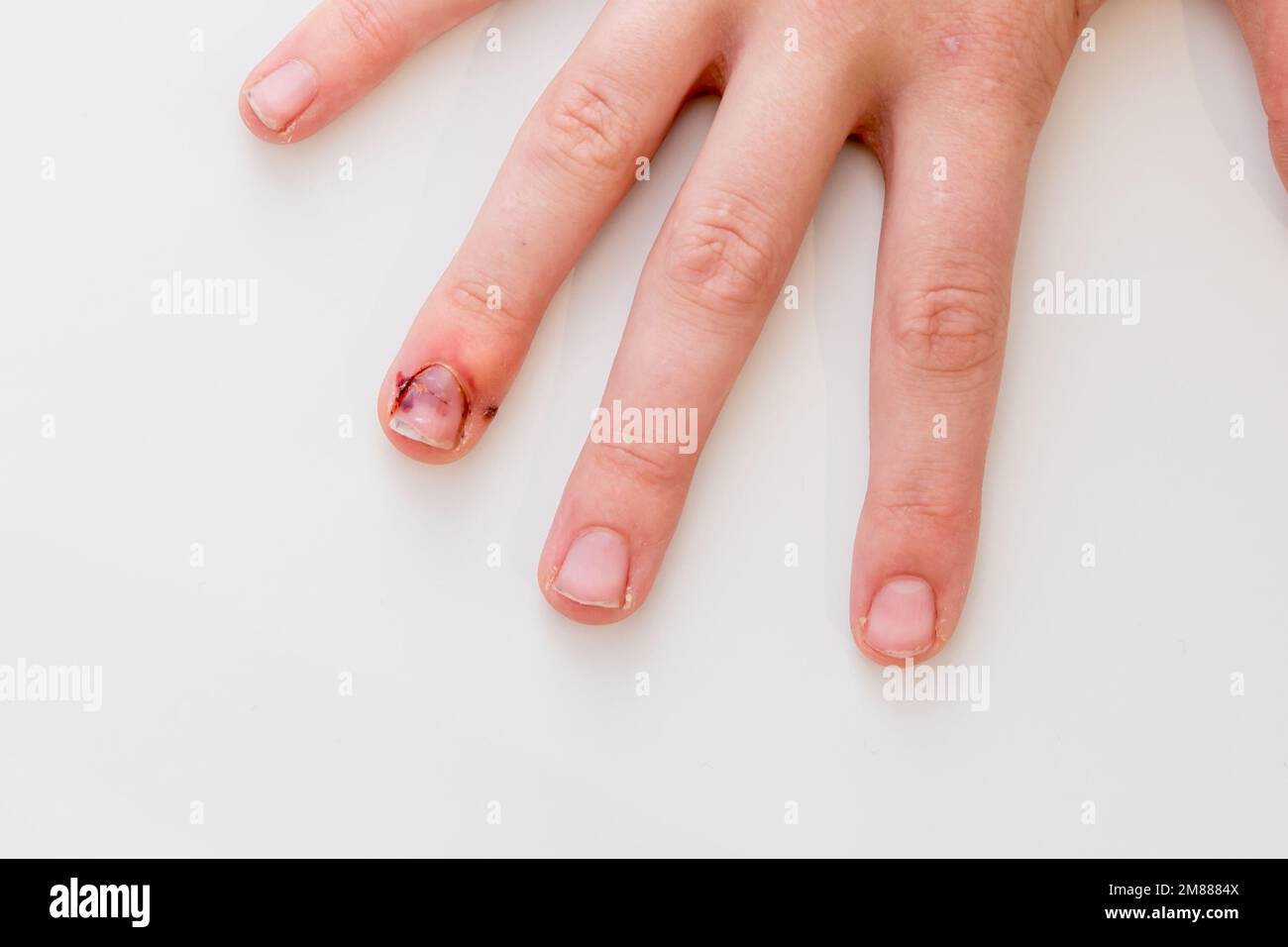 Finger eingeklemmt in der Autotür mit zerrissenem Nagel und zertrümmerter Verletzung der Fingerspitze Stockfoto