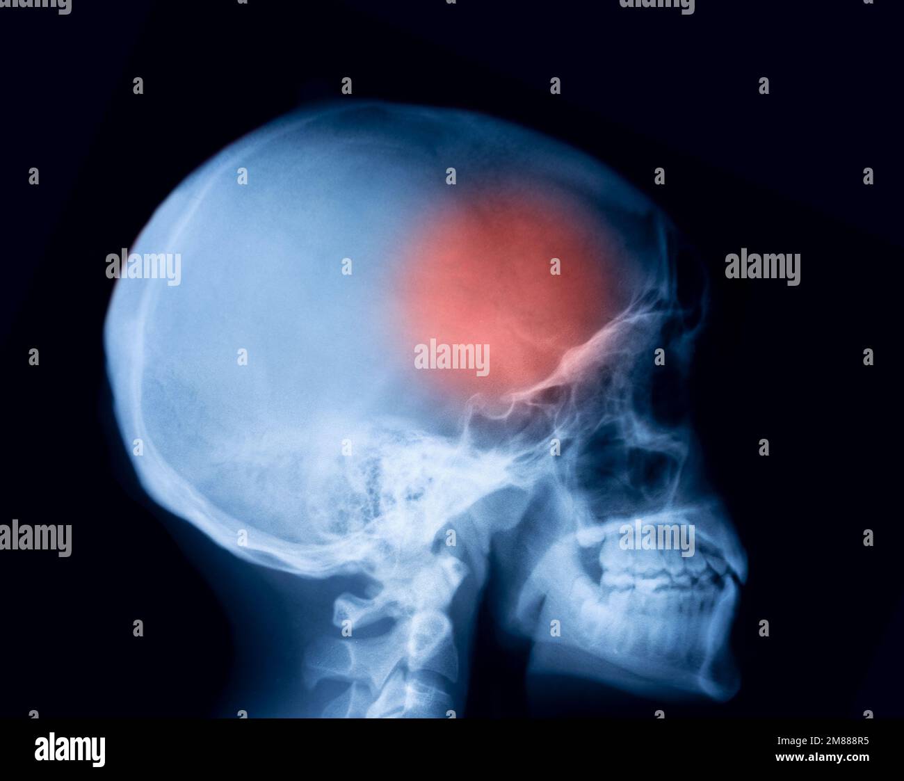 Skull fracture xray Fotos und Bildmaterial in hoher Auflösung Alamy