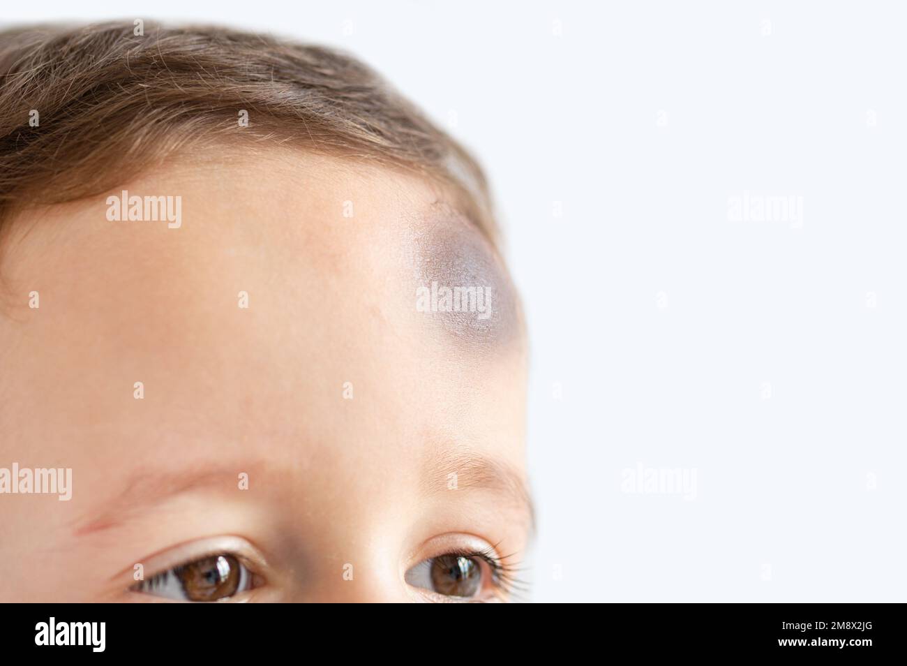 Nahaufnahme eines Jungen mit Verletzungen am Kopf und Platz für Kopien Stockfoto