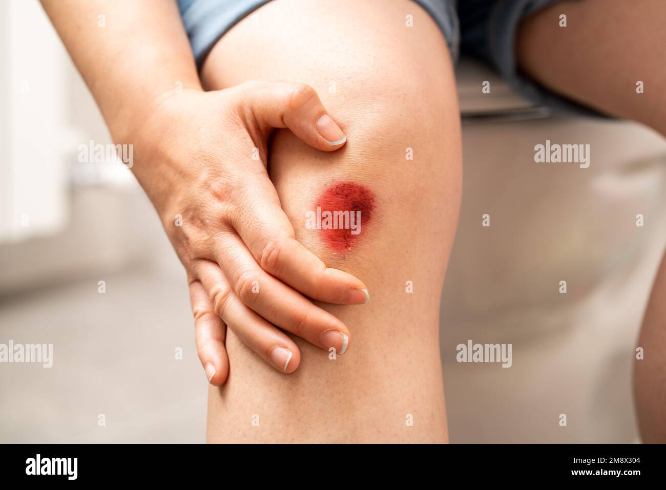 Nahaufnahme der Beine einer Frau, die mit einer blutigen Wunde auf der Toilette sitzt Stockfoto