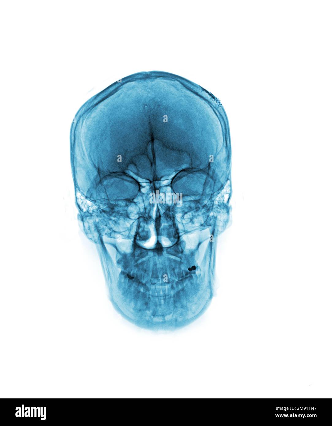 Röntgenfilmaufnahmen des normalen menschlichen Schädels auf isoliertem Hintergrund Stockfoto