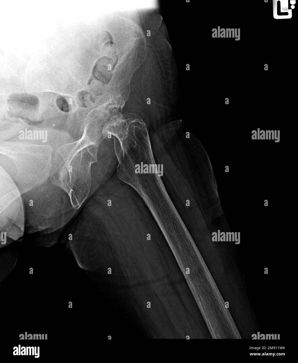 Röntgenfilmfactur Hüftgelenke, Schenkelhalsfraktur Stockfoto