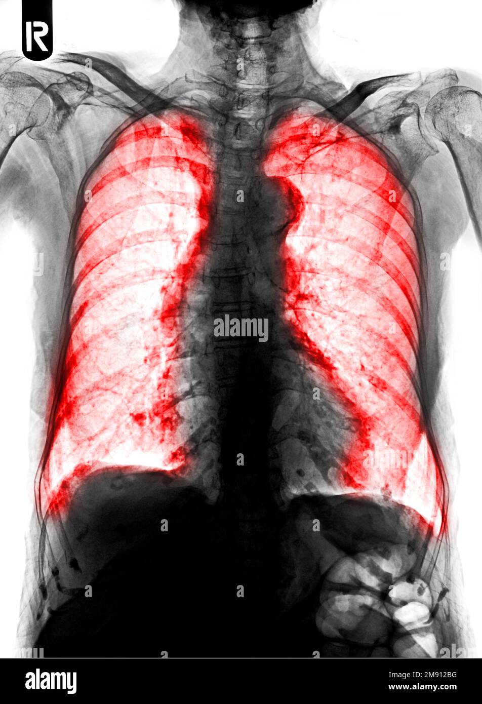 Film Thoraxröntgen zeigt interstitielle Infiltration in beiden Lungen Stockfoto