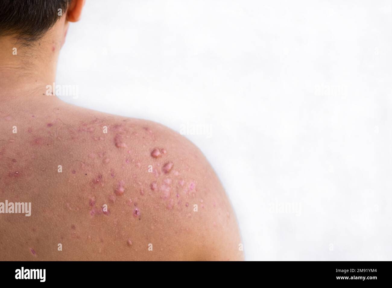 Okzipitale Akne bei einem Jugendlichen Jungen geheilt, Narben von Teenager Akne auf den Schultern, Hautinfektionen und Allergien auf den Körper eines Mannes, Gesundheit und m Stockfoto