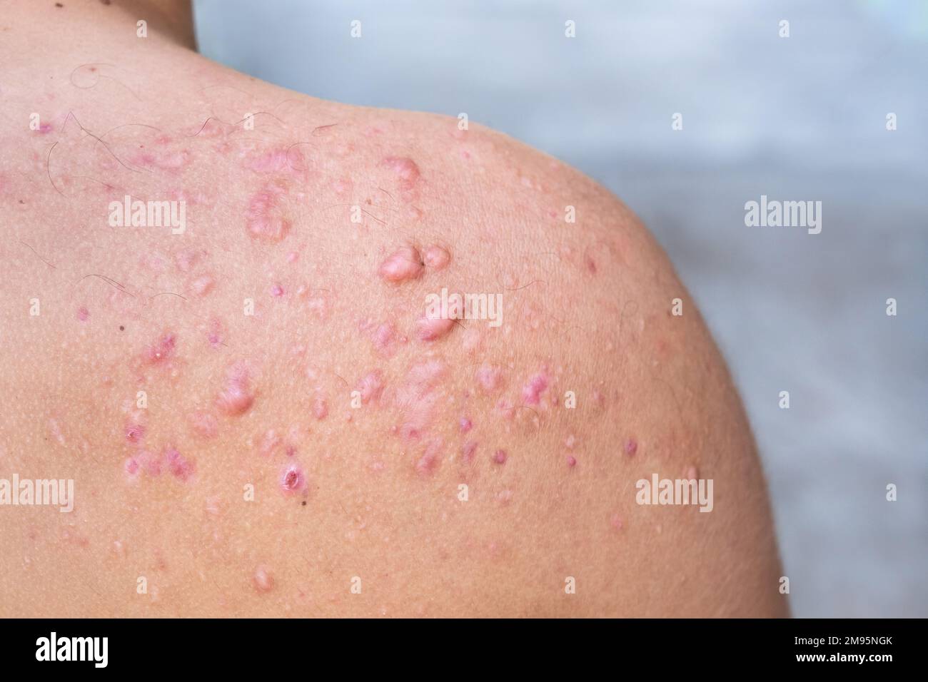 Okzipitale Akne bei einem Jugendlichen Jungen geheilt, Narben von Teenager Akne auf den Schultern, Hautinfektionen und Allergien auf den Körper eines Mannes, Gesundheit und m Stockfoto
