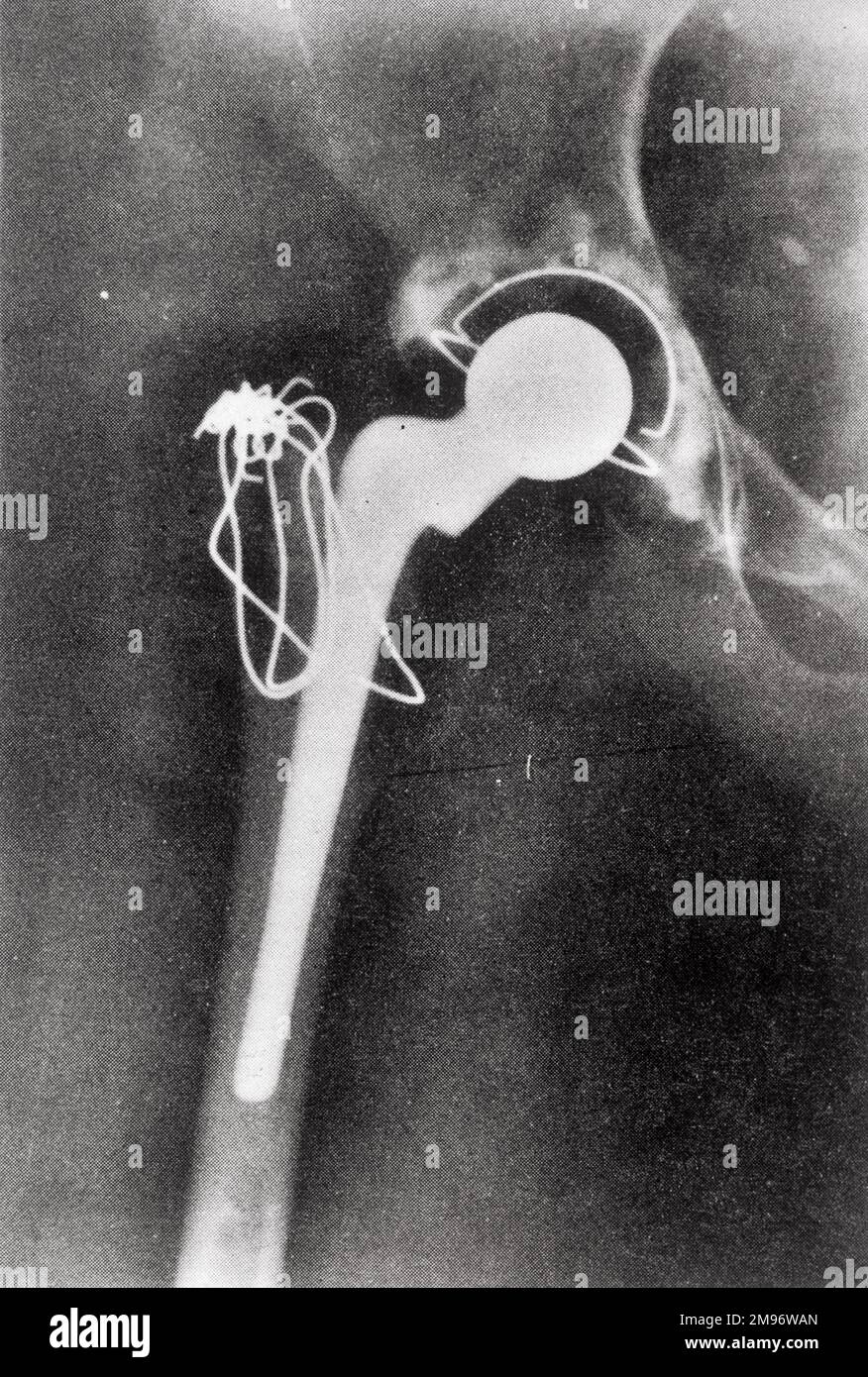 Röntgenologischer Hüftgelenkersatz Stockfoto