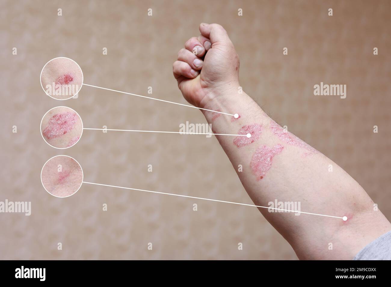 Makro detaillierte Kreise Vergrösserung der Psoriasis Armhaut mit