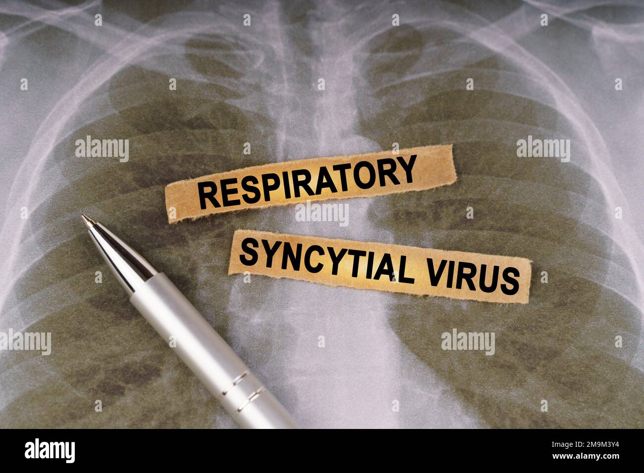 Medizinisches Konzept. Auf einem menschlichen Röntgen-Thorax, einem Stift und Streifen Papier, gekennzeichnet - Respiratory Syncytial Virus Stockfoto