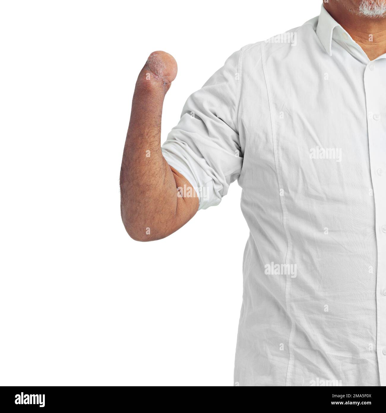Invalidität, Verletzung und Arm eines verletzten Amputierten isoliert auf weißem Hintergrund im Studio. Behinderte, Defekt und Körpergliedmaßen eines behinderten Mannes oder einer behinderten Person Stockfoto