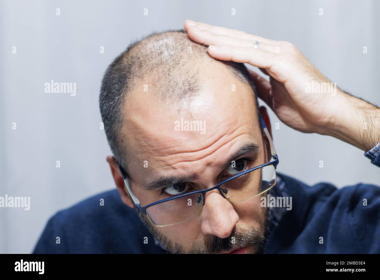 Junger Mann mit Alopezie, der Kopf und Haare im Spiegel sieht Stockfoto