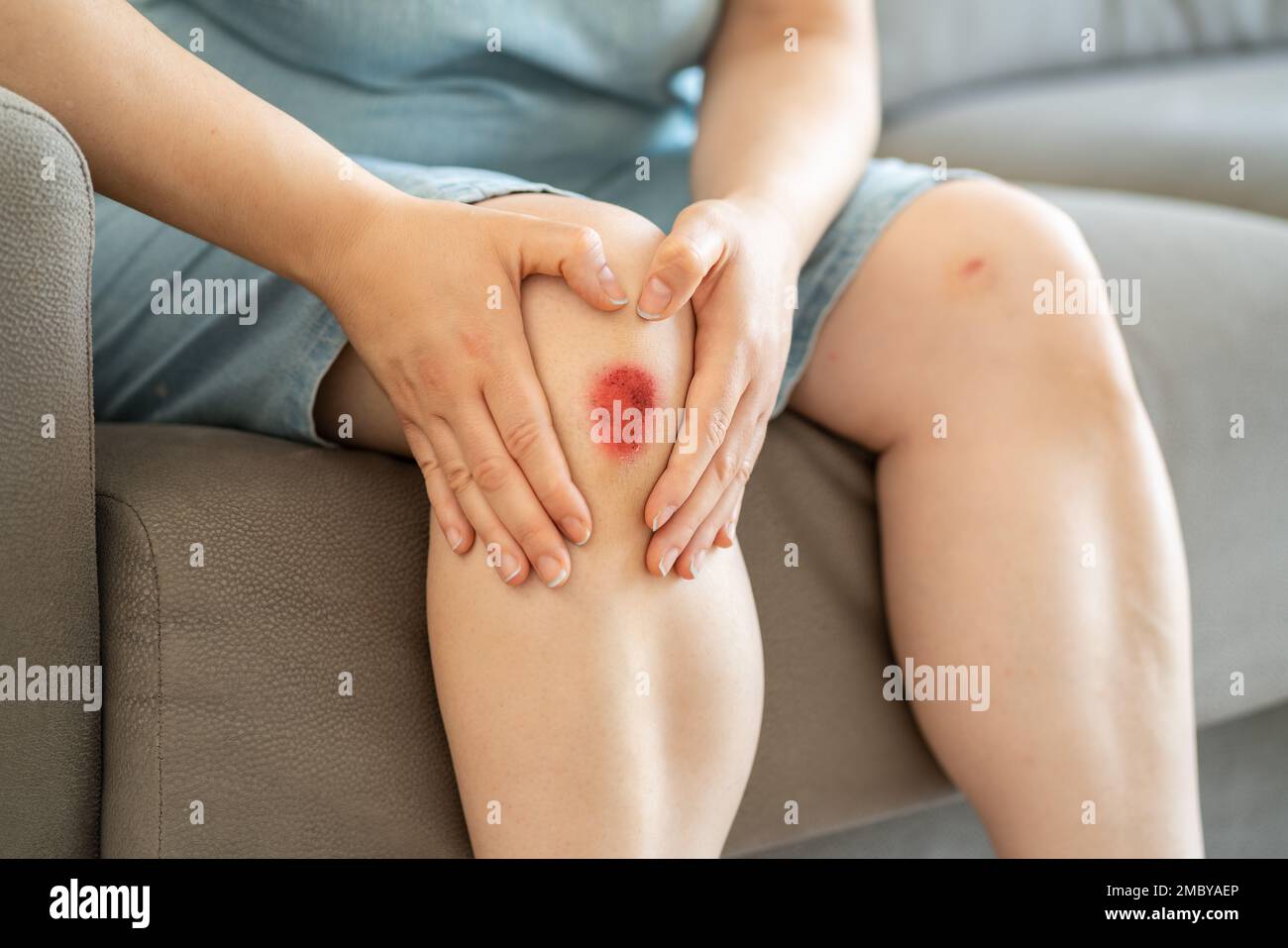 Die Beine einer Frau, die auf einer Couch sitzt und sich ihre blutige Wunde zuhause ansieht Stockfoto