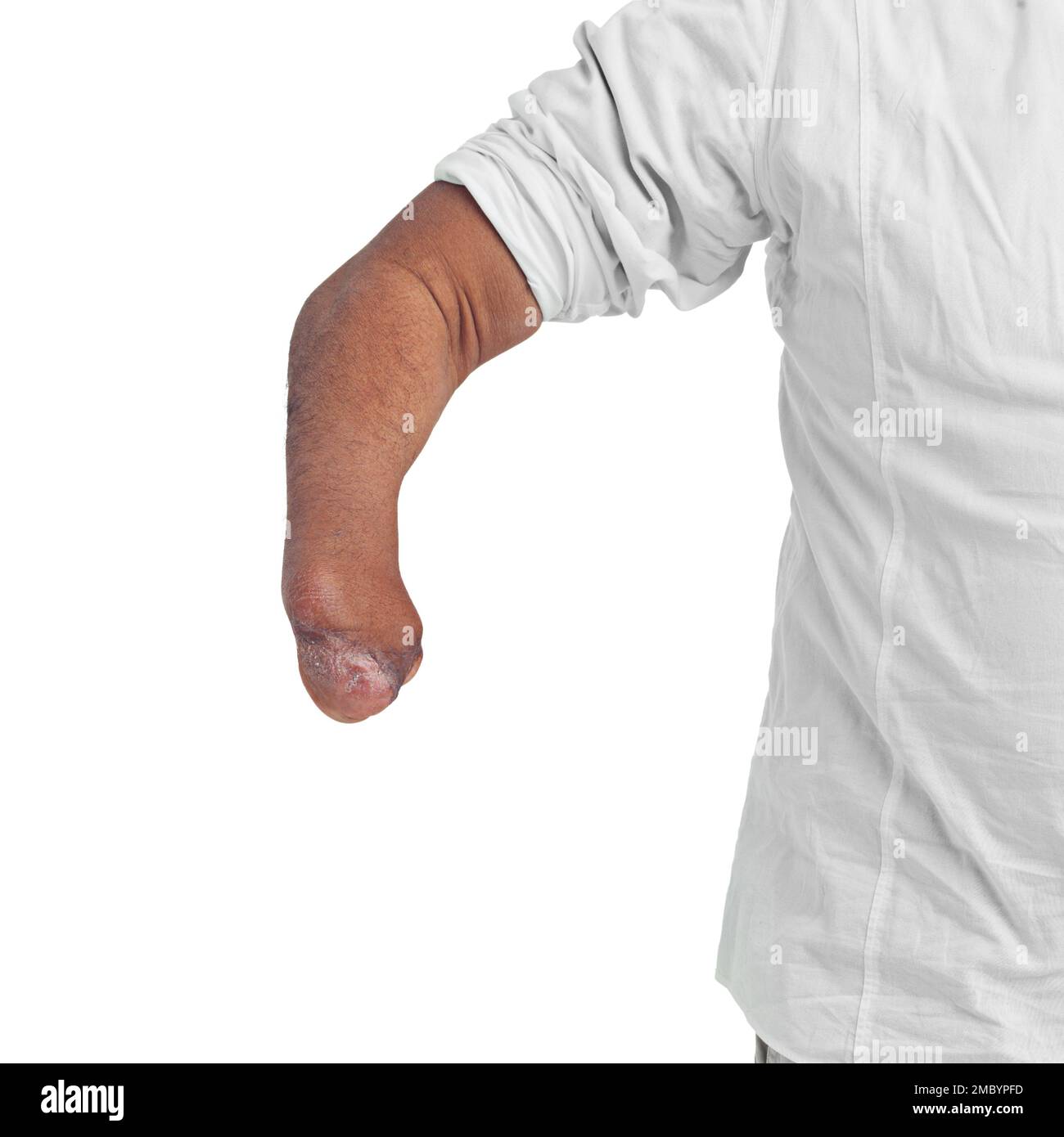 Invalidität, einzigartig und Armamputierte eines Mannes mit Verletzung am Unterarm mit Modell. Isoliertes, behindertes Modell und weißer Hintergrund eines Mannes Stockfoto