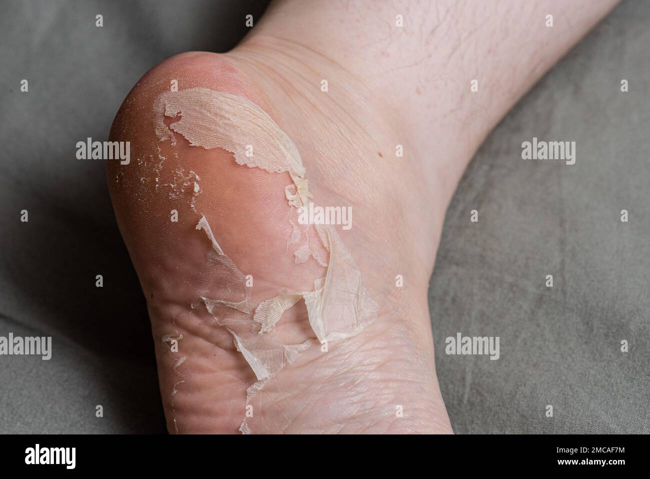 Haut blättert sich von einem Fuß ab. Stockfoto