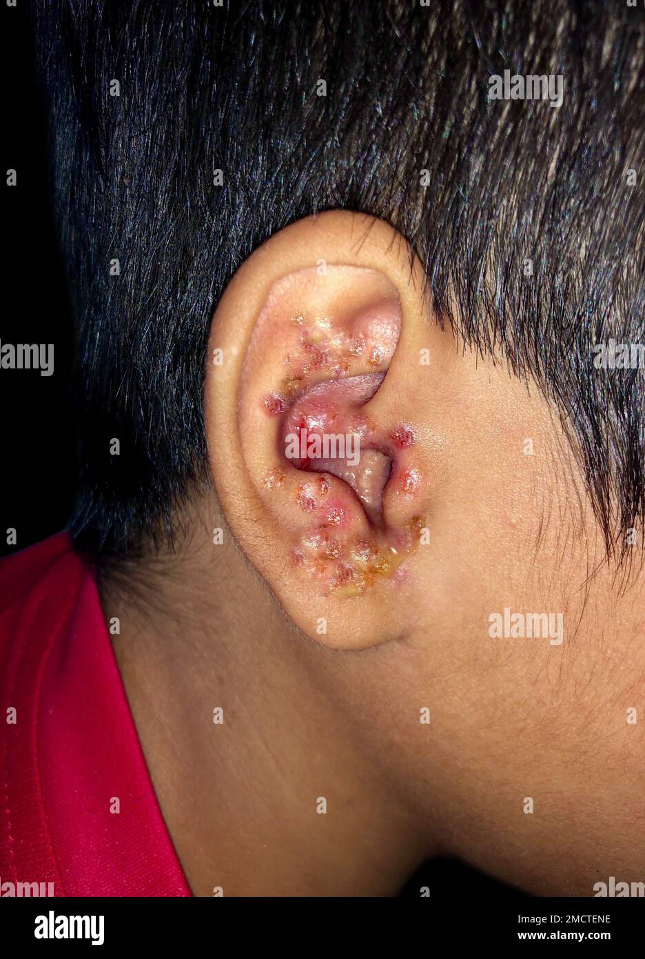 Multiple Impetigos oder zahlreiche Staphylokokken-Hautinfektionen im Ohr eines südostasiatischen Kindes. Stockfoto