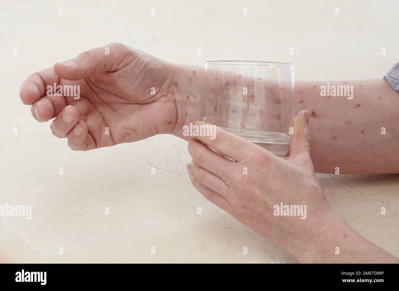 Glastest auf Hautausschlag, Meningitis-Test Stockfoto