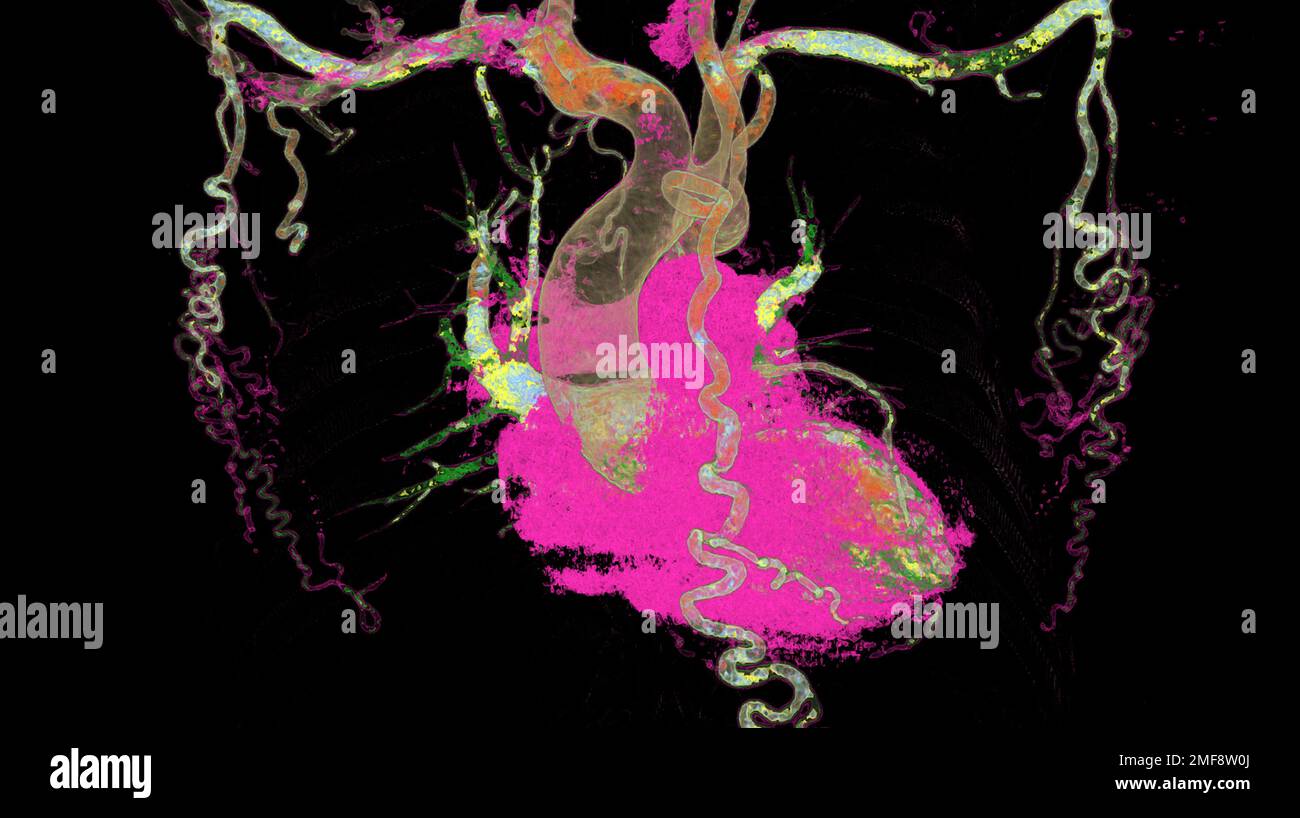 Kollateralkreislauf bei Coarctatio aortae, CT-Scan Stockfoto