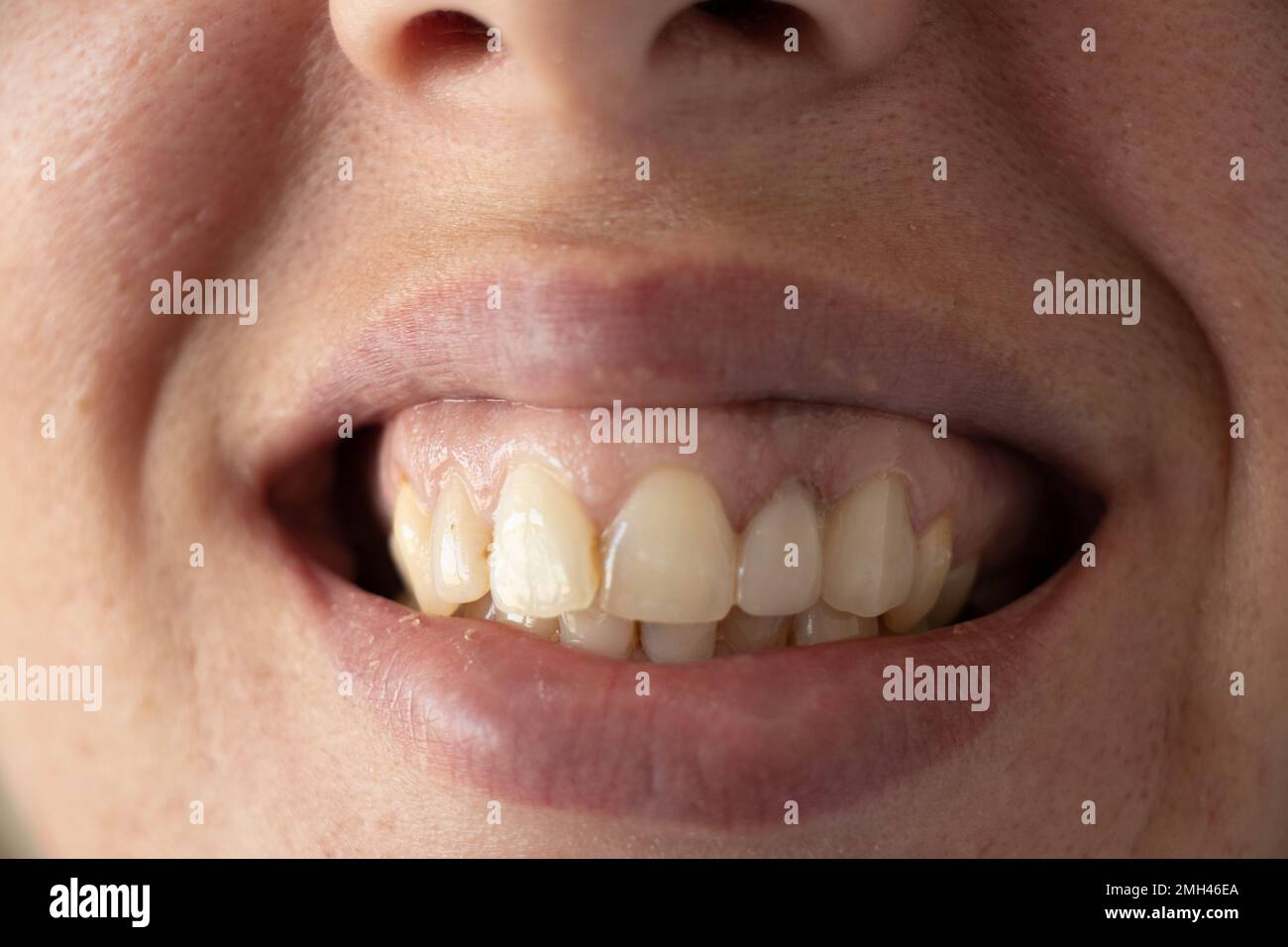 Schiefe gelbe Zähne eines jungen Mädchens aus der Nähe, offen wachsend mit schlechten Zähnen zum Beispiel, Zähnen und Mund, Karies Stockfoto