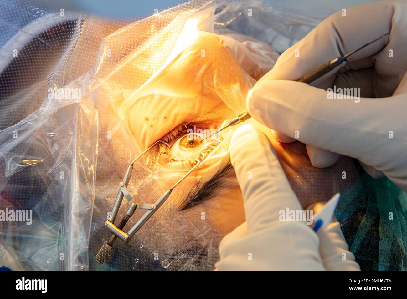 Augenchirurgie, Kataraktbehandlung und Diopterkorrektur. Chirurgische Implementierung von Multifokallinsenimplantaten. Medizinische Versorgung und Technol Stockfoto