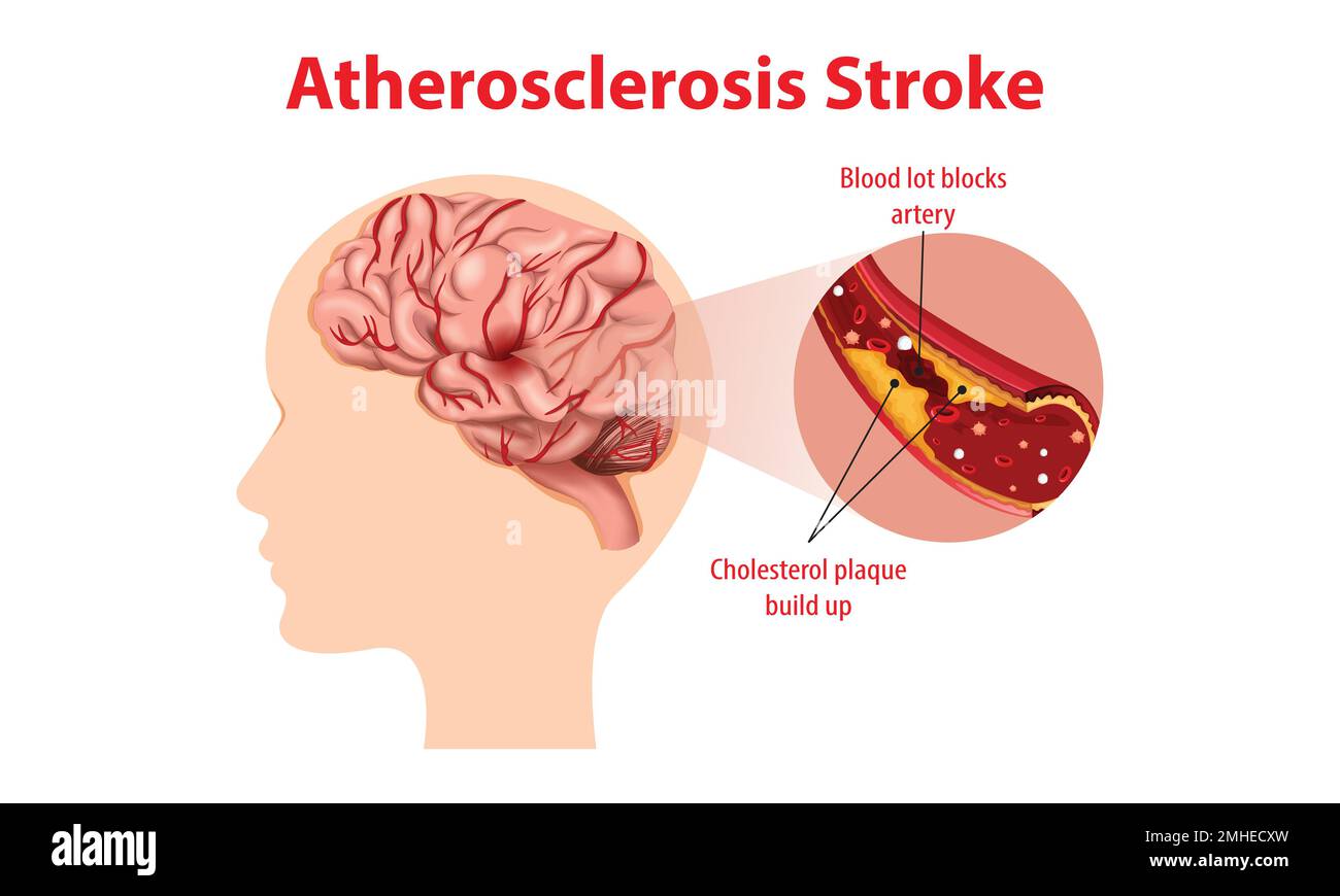 Menschliche Anatomie mit Atherosklerose-Schlaganfall Stock Vektor