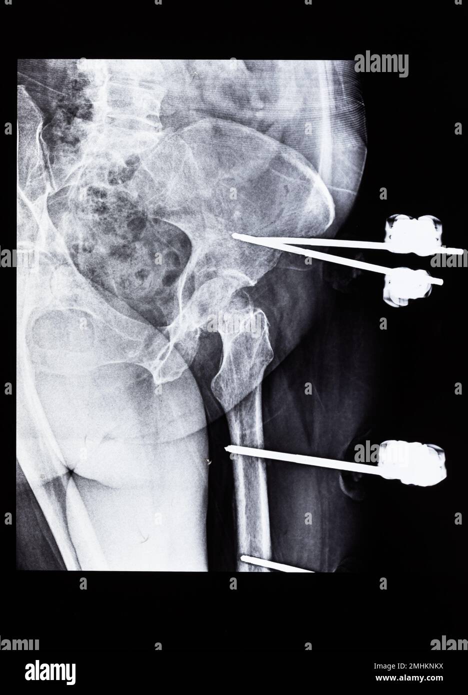 Röntgenaufnahmen mit Fixateur externe am Femur- und Beckenknochen Stockfoto