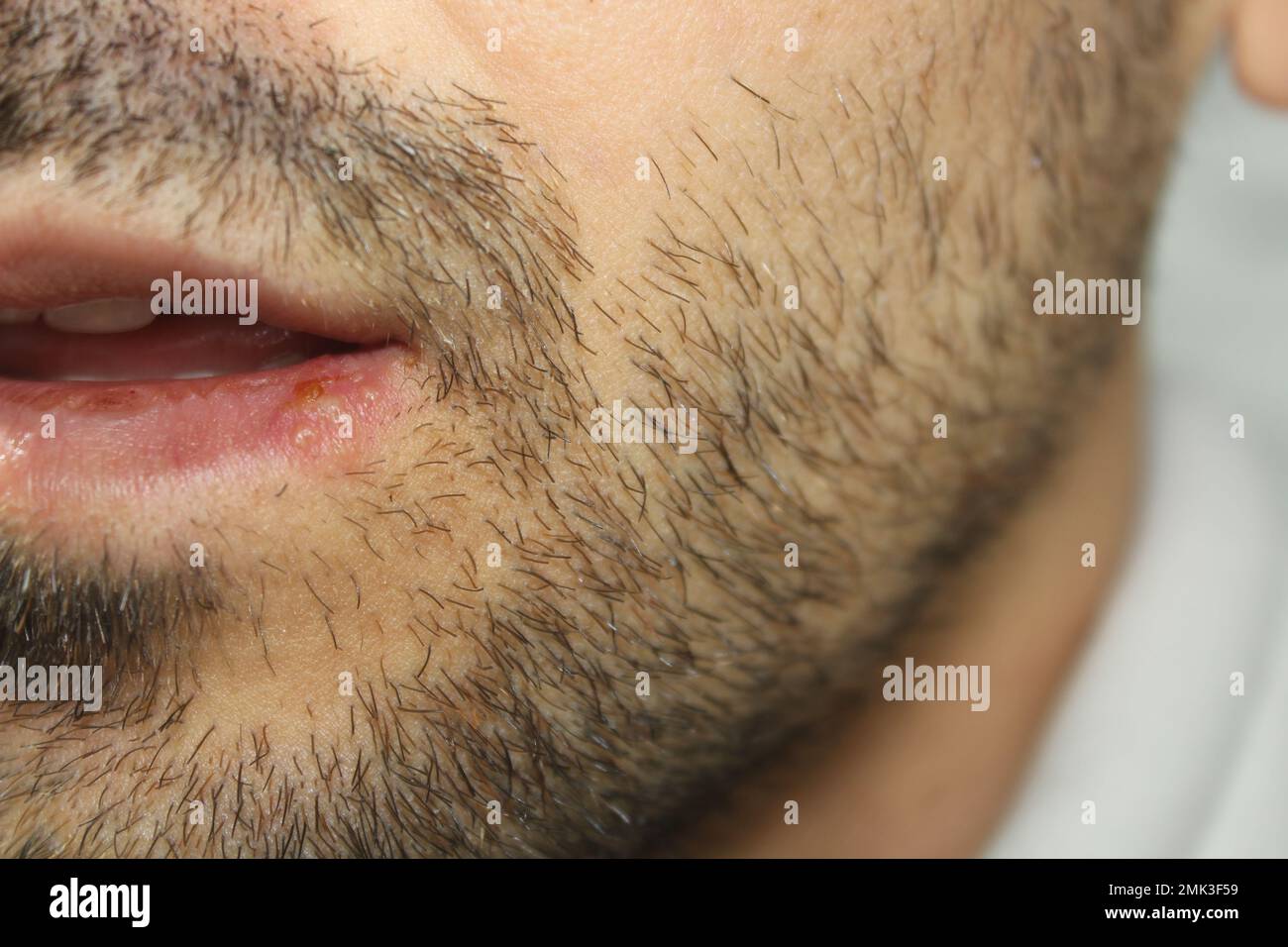 Herpes-Infektion an den Lippen eines Mannes. Nahaufnahme und selektiver Fokus auf Herpes-Infektion. Stockfoto