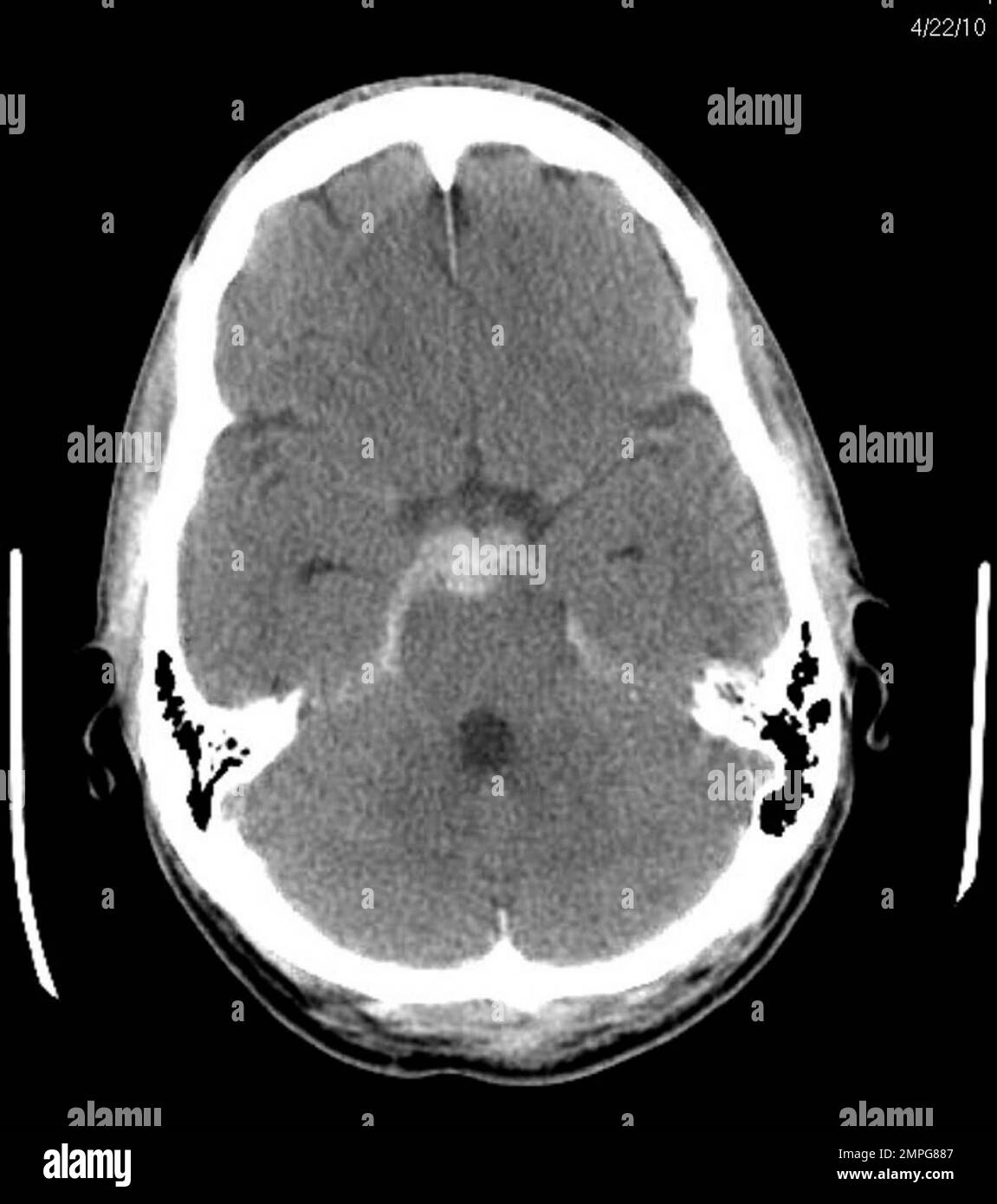 Hier ist ein Bild von Brett Michaels Cat Scan, aufgenommen im Krankenhaus, wo er nach einer lebensbedrohlichen Gehirnblutung für die letzten Tage behandelt wurde. Der Rockstar wurde heute aus dem Krankenhaus des Barrows Neurological Institute im St. Josephs Hospital in Phoenix, Arizona, entlassen. 5/4/10. Stockfoto