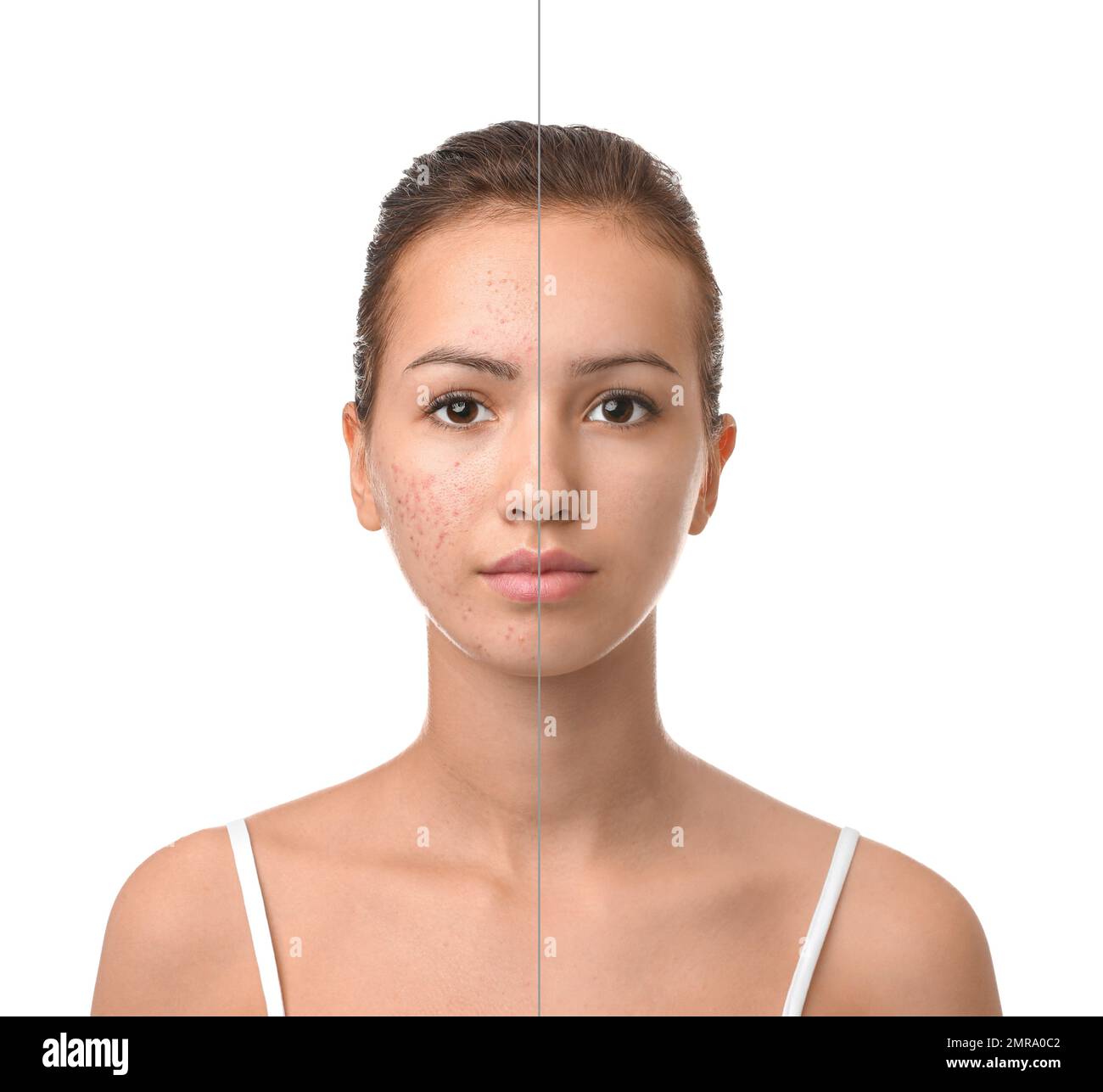 Teenager vor und nach Aknebehandlung auf weißem Hintergrund Stockfoto