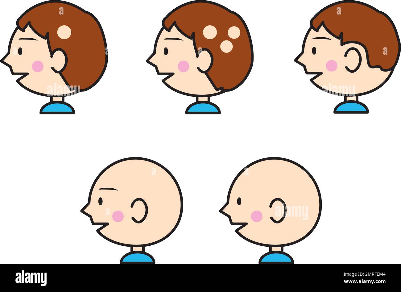 Eine süße Profildarstellung, die die Art der Alopezie zeigt. Medizinische Illustration. Stock Vektor