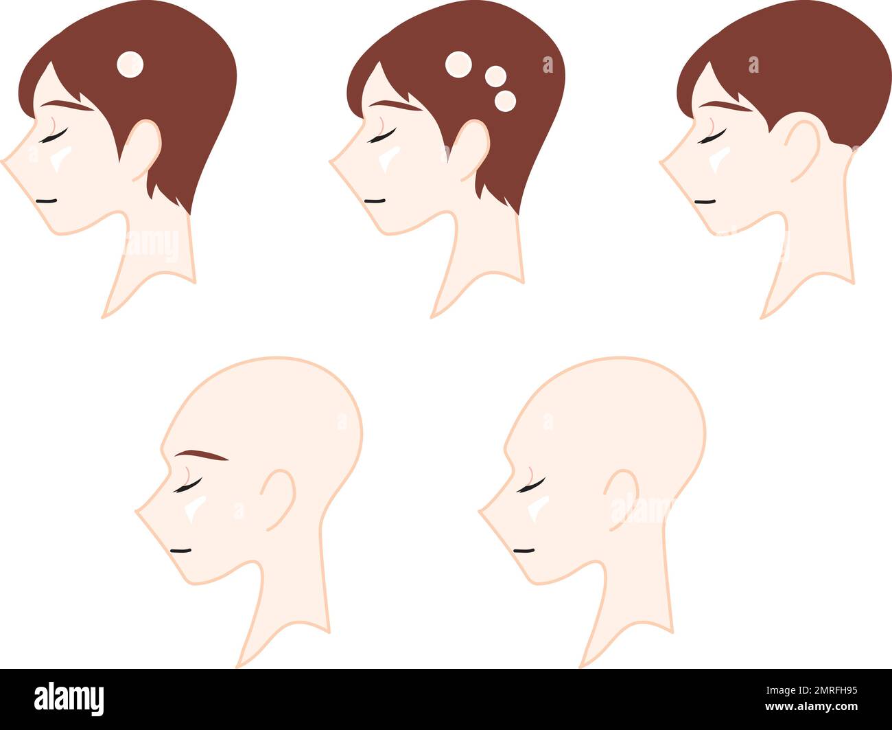 Das Profil einer neutralen Person, die den Typ der Alopezie darstellt. Medizinische Illustration. Stock Vektor