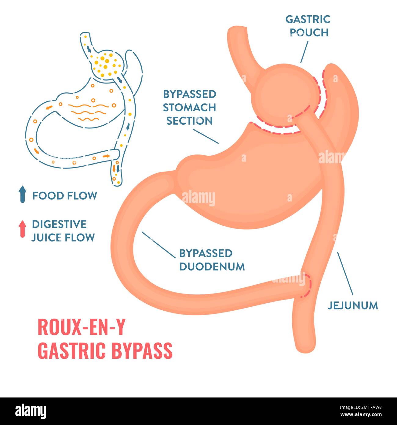 Infografiken zur Gewichtsabnahme nach Roux-en-y-Magenbypass bariatrische Chirurgie Stock Vektor