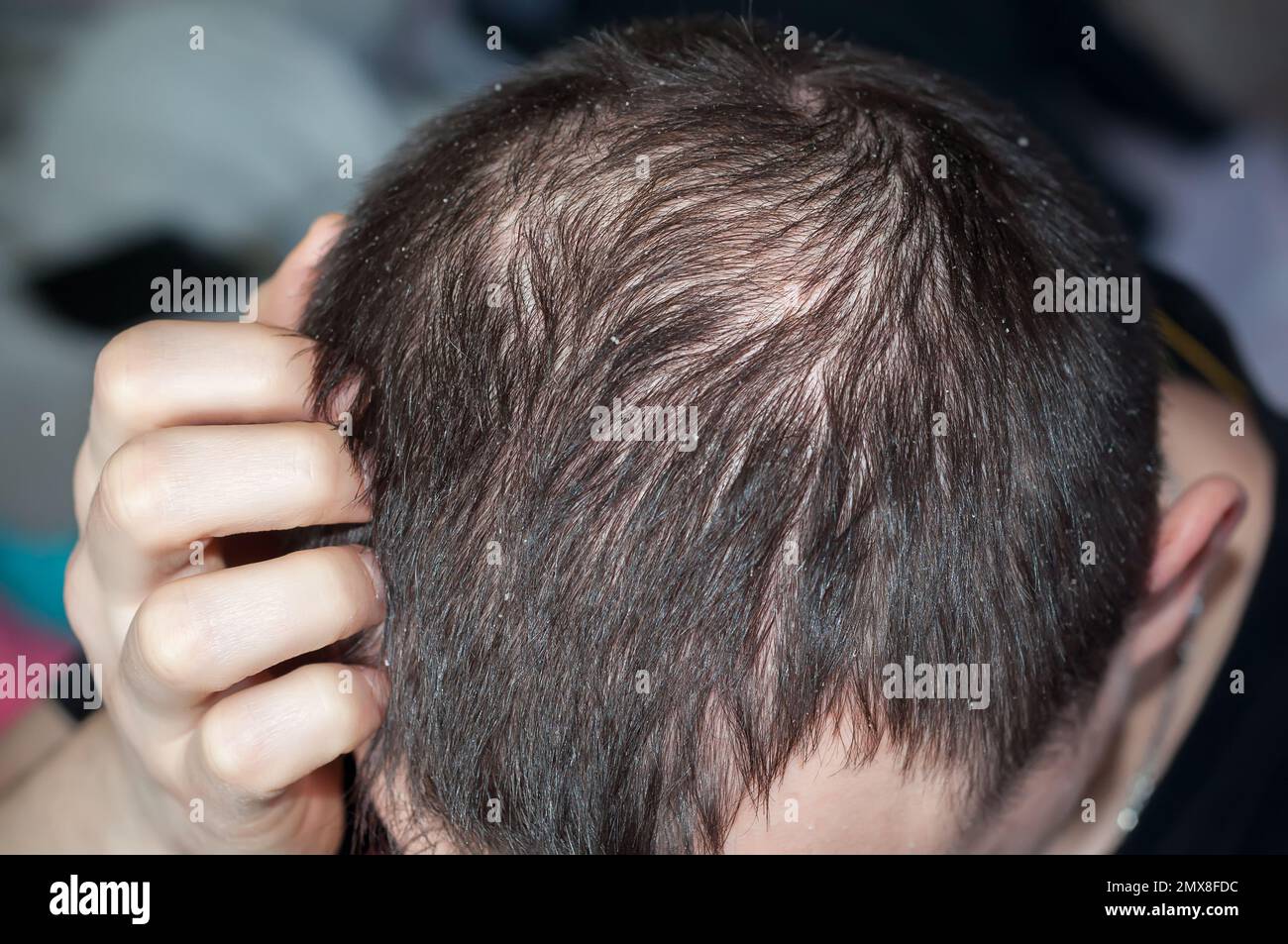Schuppen bei einem Mann und Haarausfall. Männlicher Kopf mit kurzen Haaren und kahlem Kopf. Seborrhoe ist eine Erkrankung des Nervensystems Stockfoto